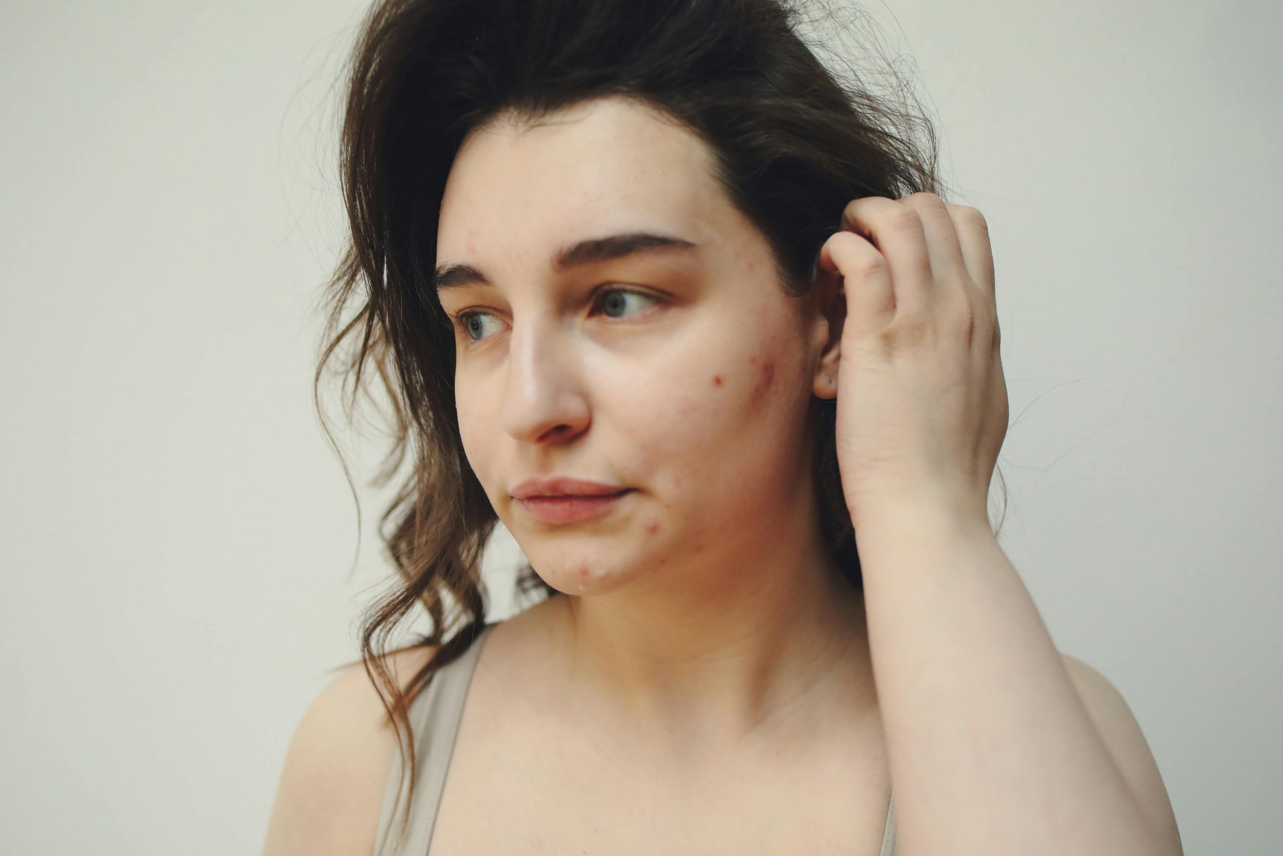 woman with acne tucking her hair behind her ear